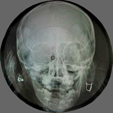 One-sided flexible record made of X-ray pattern – односторонняя гибкая пластинка, сделанная из рентгеновского снимка