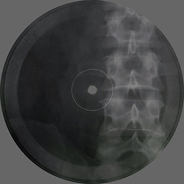 One-sided flexible record made of X-ray pattern – односторонняя гибкая пластинка, сделанная из рентгеновского снимка