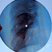 One-sided flexible record made of X-ray pattern – Односторонняя гибкая пластинка, сделанная из рентгеновского снимка