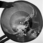 One-sided flexible record made of X-ray pattern – Односторонняя гибкая пластинка, сделанная из рентгеновского снимка