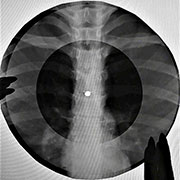 One-sided flexible record made of X-ray pattern – Односторонняя гибкая пластинка, сделанная из рентгеновского снимка