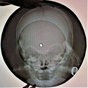 One-sided flexible record made of X-ray pattern – Односторонняя гибкая пластинка, сделанная из рентгеновского снимка