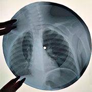 One-sided flexible record made of X-ray pattern – Односторонняя гибкая пластинка, сделанная из рентгеновского снимка