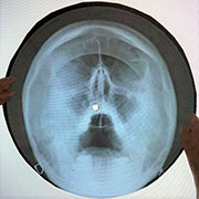 One-sided flexible record made of X-ray pattern – Односторонняя гибкая пластинка, сделанная из рентгеновского снимка